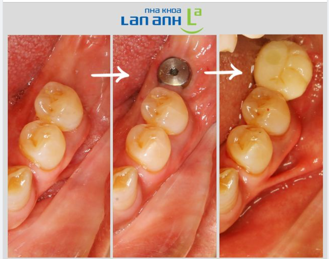 Đặt Implant nhẹ nhàng, không đau, không chảy máu, là khi nào?