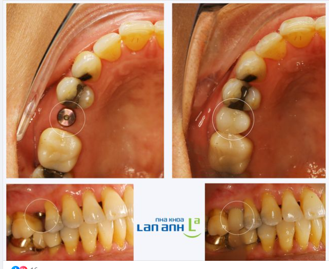 Bên nha khoa có nhận làm răng sứ trên Implant đã đặt ở nước ngoài không?