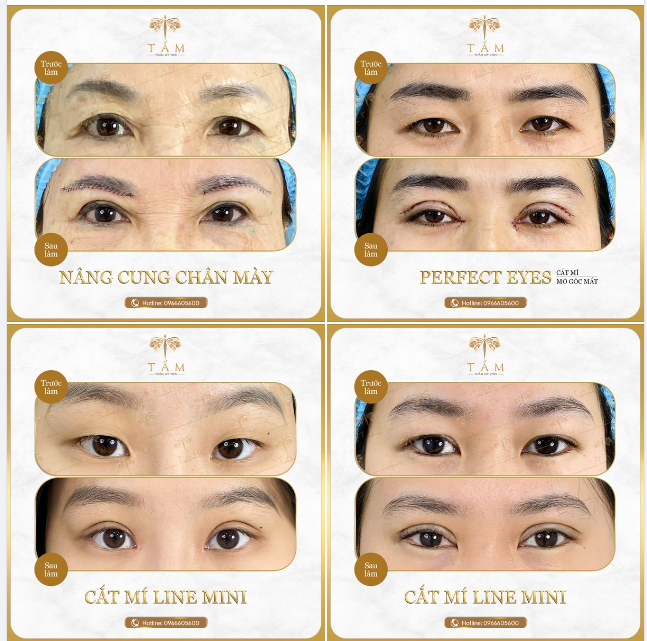 Tổng hợp hình ảnh trước sau của khách hàng tới Tấm sử dụng các dịch vụ cắt mí, mở góc mắt, nâng cung chân mày...