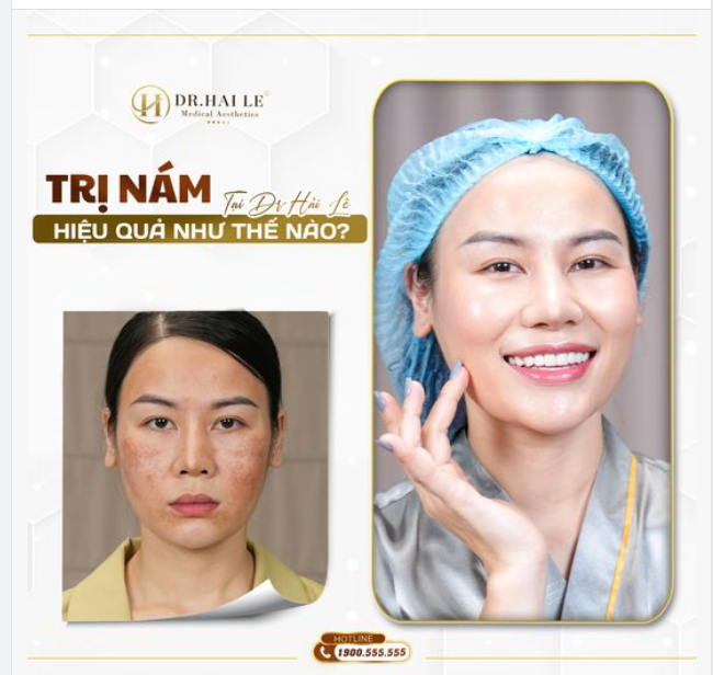 Hiệu quả trị nám tại Dr.Hải Lê không phải là khi đến đây với làn da nhiều nám bạn sẽ mang về một làn da giảm nám đáng kể mà là một làn da sạch nám và căng-trắng-sáng-bóng-mịn.
