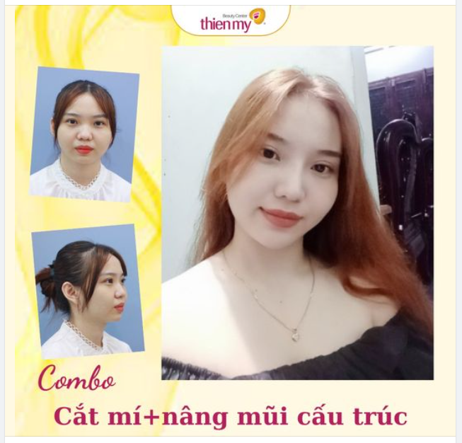 Combo lột xác Cắt mí Extra lift, Nâng mũi cấu trúc