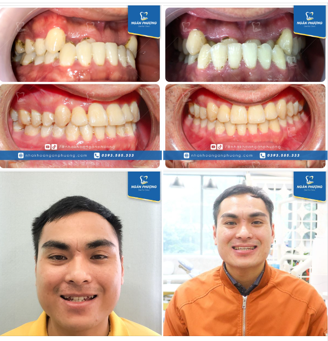 Chúc mừng anh Thiện có nụ cười mới đón Tết. Khớp cắn sâu, răng hàm trên khấp khểnh nặng nay đã được dàn đều, khuôn răng đẹp mê ly.