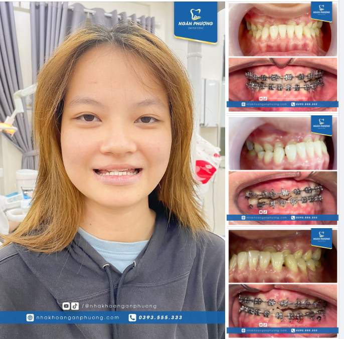 Phép màu của niềng răng Từ độ cắn phủ âm đến răng đều đẹp chỉ sau 1 năm