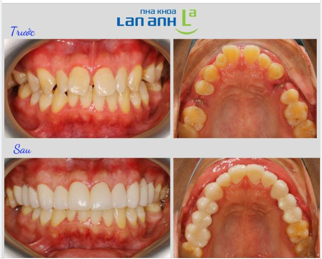 Răng sứ làm, có quan trọng ở mặt trong không