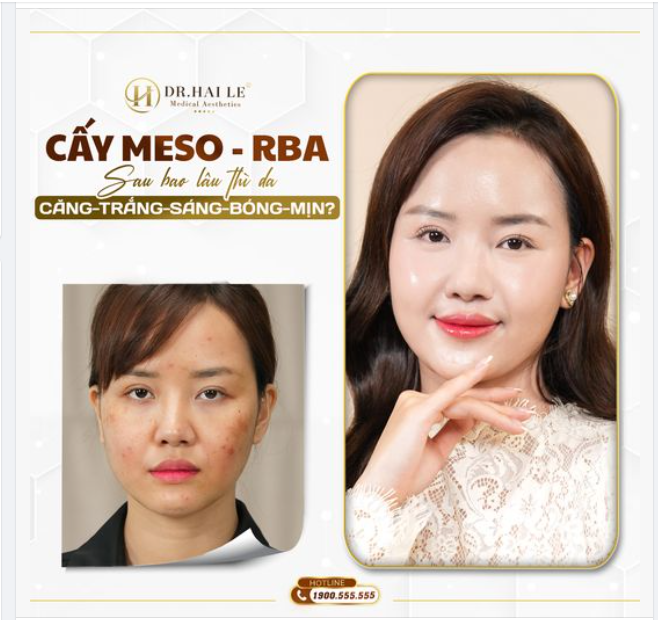 Tổ hợp công nghệ trị liệu tái tạo tái sinh làn da đa lớp Medi-RBA tại Dr.Hải Lê ngày càng được rất nhiều chị em ưa chuộng.