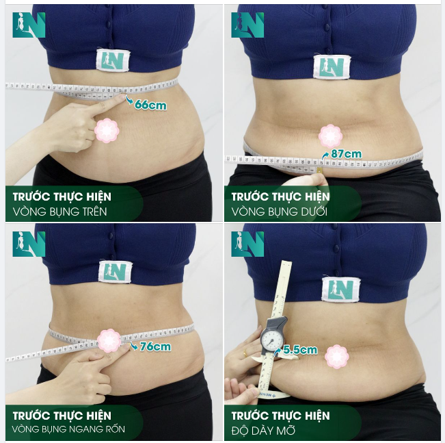 HÌNH ẢNH TRƯỚC KHI THỰC HIỆN HÚT MỠ TẠO DÁNG TẠI EKIP BÁC SĨ LƯƠNG NGỌC