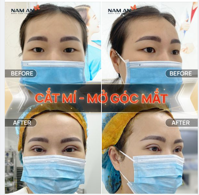 MẮT TO TRÒN NGAY SAU PHẪU THUẬT