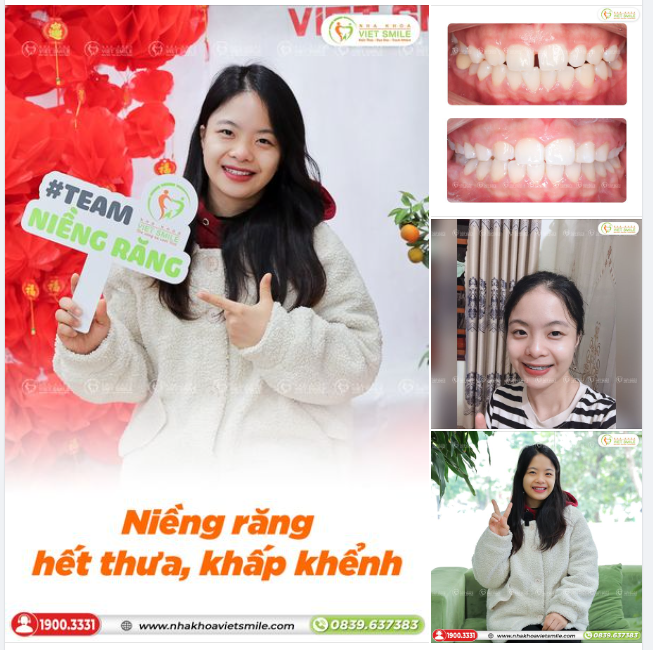 NIỀNG RĂNG KHẮC PHỤC RĂNG THƯA, KHẤP KHỂNH