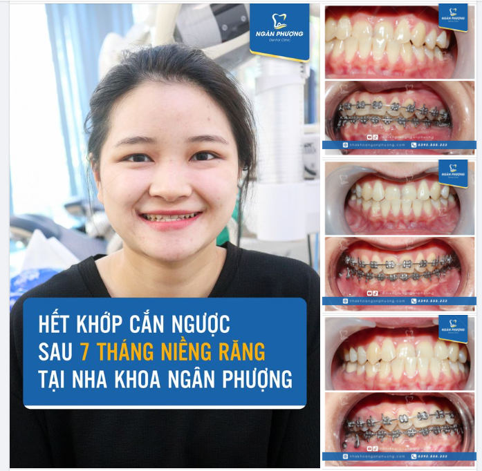 Lại một ca khớp cắn ngược đều đẹp nhờ niềng răng chỉ sau 7 tháng