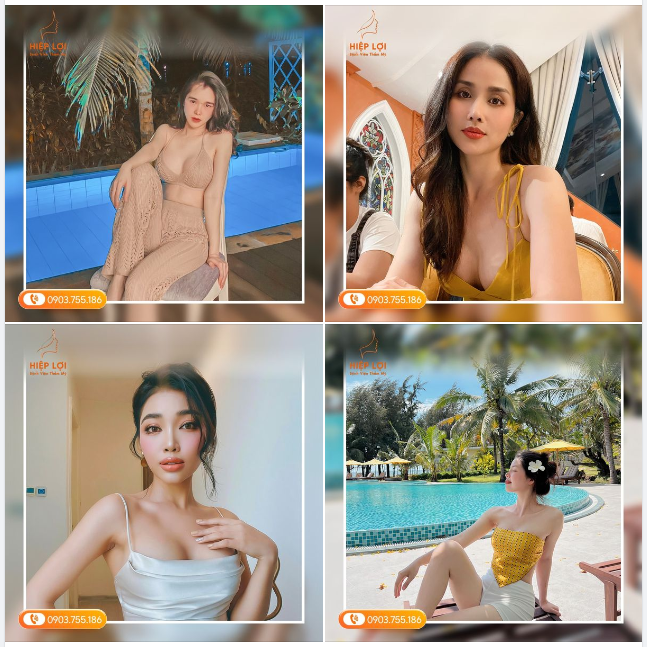 Nâng ngực tại Hiệp Lợi có ĐẸP như lời đồn không?