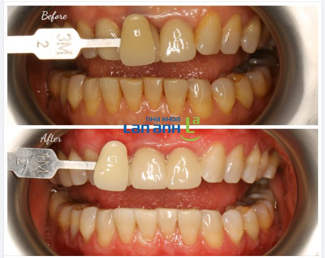 Răng sậm màu có tẩy trắng răng đạt kết quả không?