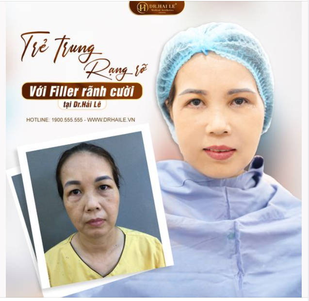  Nếu bạn muốn có một rãnh cười đầy đặn, trẻ trung, rạng rỡ, tiê.m filler tại Dr.Hải Lê chính là giải pháp tuyệt vời dành cho bạn.