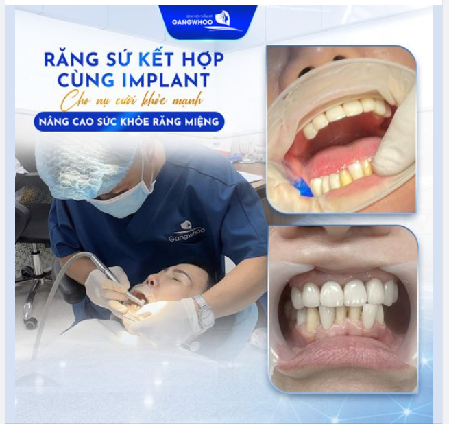 RĂNG SỨ TOÀN HÀM LAVA KẾT HỢP CÙNG IMPLANT CHO BẠN NỤ CƯỜI CHẮC KHỎE