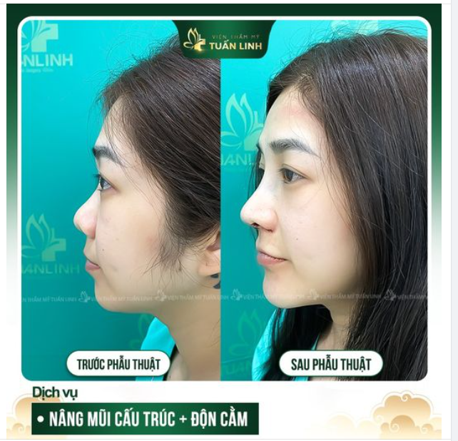 Nâng mũi cấu trúc + Độn Cằm  Combo đẹp toàn diện!