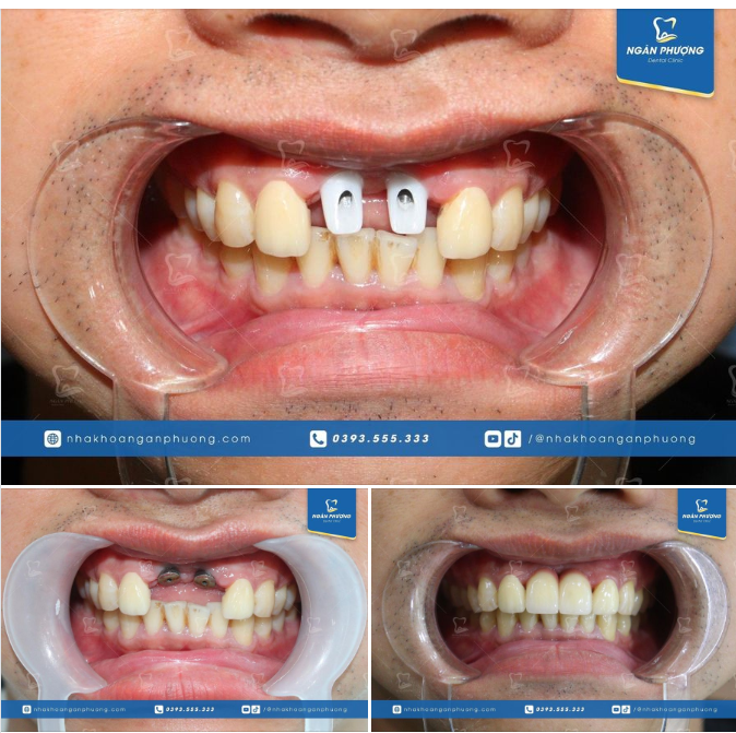 3 giai đoạn phục hình hoàn hảo implant cho các bạn bị mất răng cửa