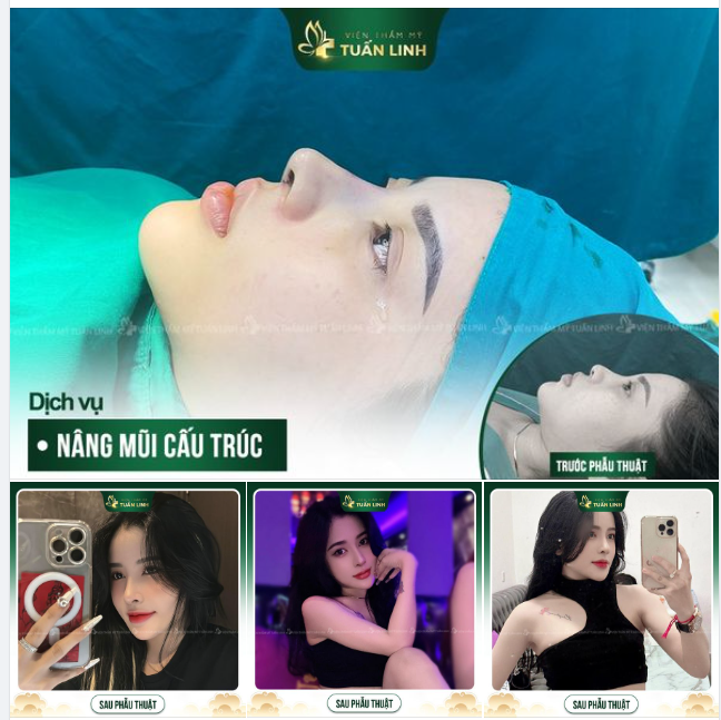 Trẻ trung hơn, xinh đẹp hơn sau nâng mũi!! Chính là khách hàng nhà Tuấn Linh.
