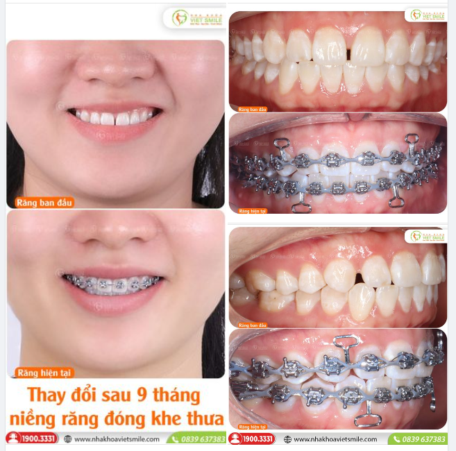 THAY ĐỔI SAU 9 THÁNG NIỀNG RĂNG ĐÓNG KHE THƯA