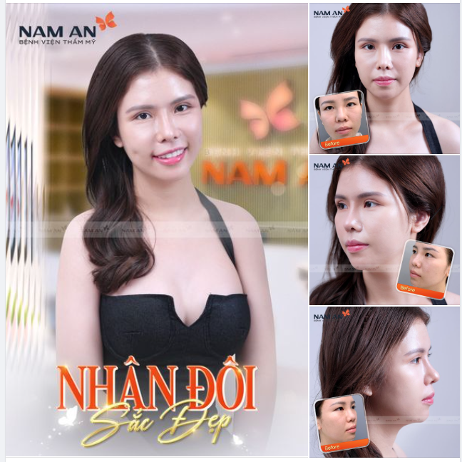 NÂNG MŨI CẮT MÍ - NHÂN ĐÔI SẮC ĐẸP