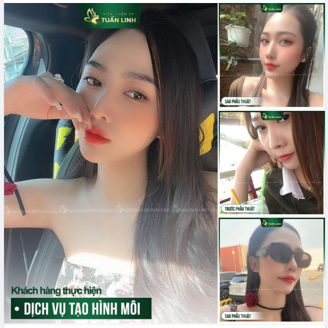 Sở hữu ngay bờ môi ngọt ngào, gợi cảm chỉ sau 30 phút thực hiện.