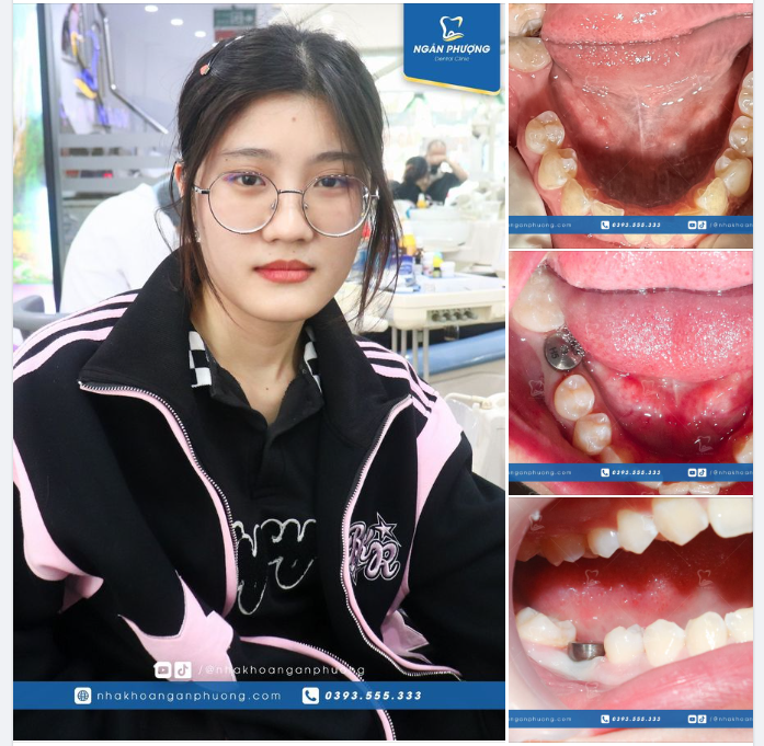 Chúc mừng và hẹn Ánh Thu phục hình sau 4 - 6 tháng nữa nhé