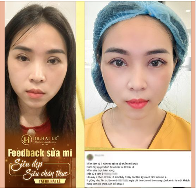 Flex những dòng chia sẻ chuẩn 10đ không có nhưng của bạn khách sau khi sửa mí thành công tại Dr.Hải Lê: