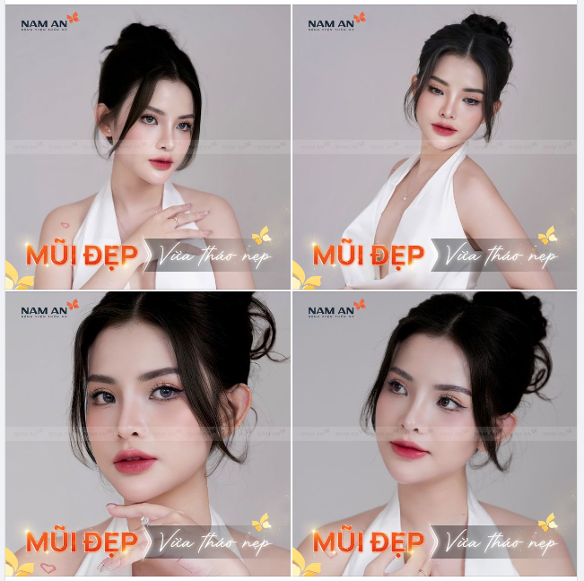 DÁNG MŨI SAU THÁO NẸP