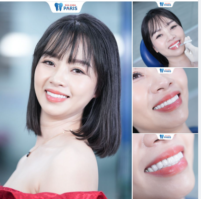 ĐÁNH THỨC NỤ CƯỜI TỰ TIN SAU BỌC SỨ