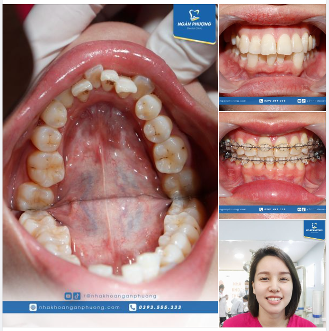Bỉ ngạn hồng, không còn khấp khểnh