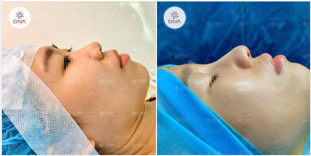 NÂNG MŨI TINY POINT - DÁNG MŨI CAO TỰ NHIÊN, CÂN ĐỐI