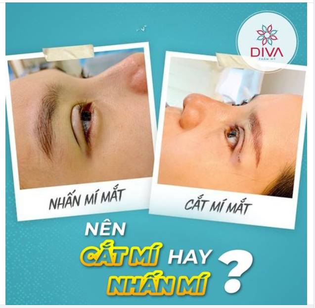 NÊN NHẤN MÍ HAY CẮT MẮT 2 MÍ ?