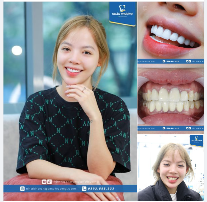 Hình thể răng duyên dáng hơn. Màu sáng, tôn da nhưng vẫn có rìa trong tự nhiên. Và biết thế tìm tới Ngân Phượng sớm hơn