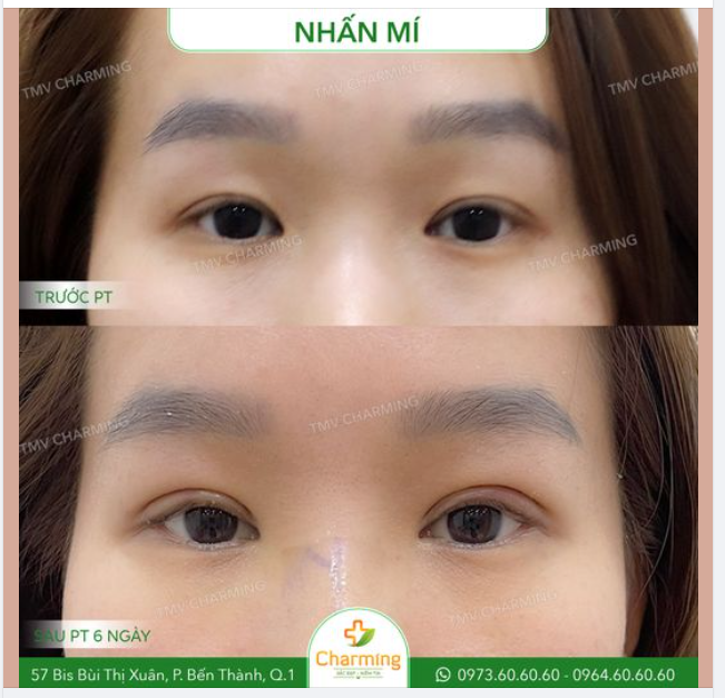 Những bạn trẻ bao giờ cũng thế, da và mỡ mắt luôn trong tình trạng tốt nhất nhưng mí mắt thì ít khi nào chịu hợp tác để cho ra đôi mắt đẹp.