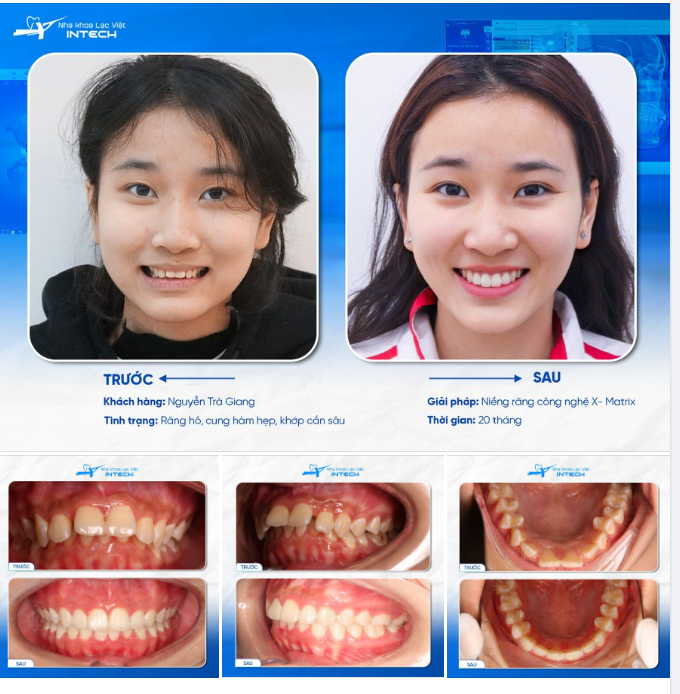 TẠM BIỆT HÀM RĂNG “NẠO DỪA”, CÔ GÁI LỘT XÁC NGỠ NGÀNG SAU KHI NIỀNG RĂNG!