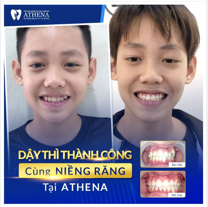 DẬY THÌ THÀNH CÔNG NHỜ NIỀNG RĂNG ĐÚNG ĐỘ TUỔI VÀNG
