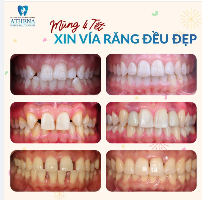 MÙNG 4 TẾT ATHENA "NHẢ VÍA" RĂNG ĐỀU ĐẸP CHO TẤT CẢ MỌI NGƯỜI