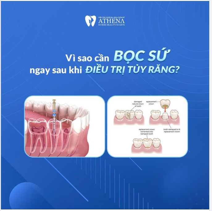 BẠN CẦN BỌC SỨ NGAY SAU KHI ĐIỀU TRỊ TỦY RĂNG NẾU KHÔNG SẼ RẤT NGUY HIỂM, TẠI SAO LẠI VẬY?