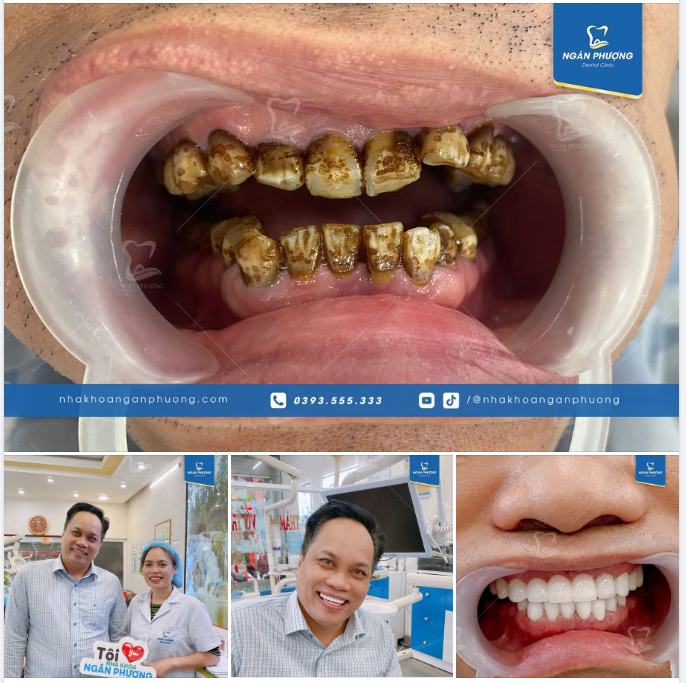 Răng trước làm của anh gặp rất nhiều vấn đề: Thiểu sản men răng, nhiễm tetra và răng bị mòn mặt nhai hầu hết răng cửa.
