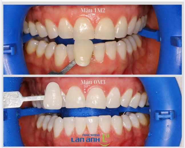 Tẩy trắng răng là kỹ thuật đơn giản và tiết kiệm chi phí để màu răng trắng đẹp chỉ sau 60 phút!
