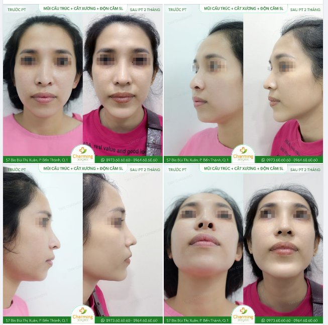Nếu bạn không hề tăng cân mà mặt cứ có cảm giác không cân đối với cơ thể thì có thể là do phần cằm của bạn thiếu đấy.