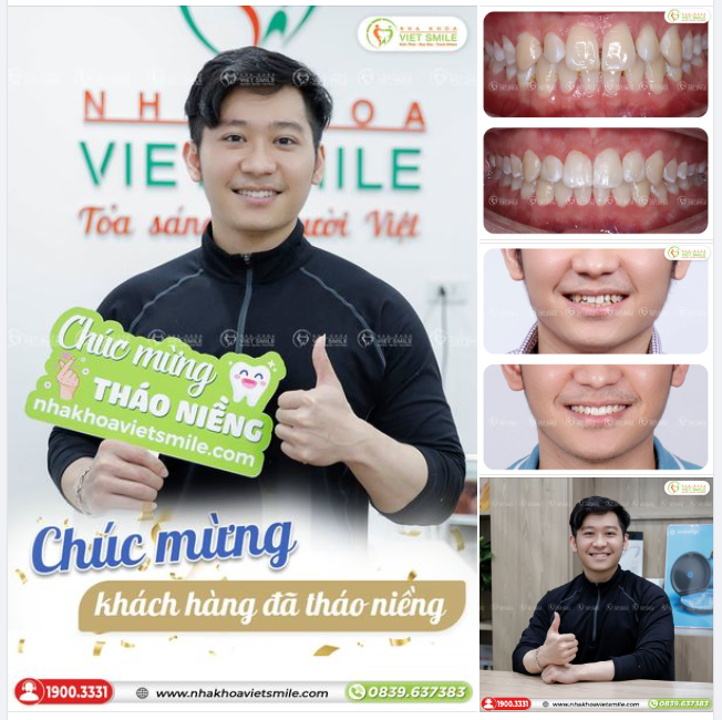 THÁO NIỀNG RĂNG THƯA CHỈ SAU HƠN 1 NĂM ĐEO NIỀNG