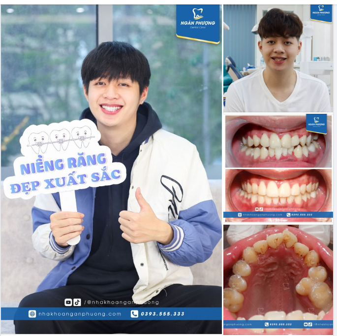 Niềng răng xong đẹp trai như Lee Minho thời trẻ" - Bác sĩ phải thốt lên khi tháo niềng cho Quang Anh.