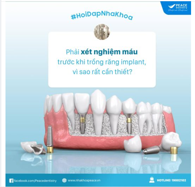 Vì sao cần phải xét nghiệm máu trước khi thực hiện trồng răng implant?