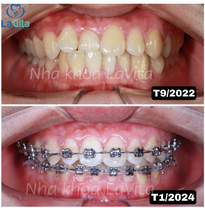 NIỀNG RĂNG MẮC CÀI KIM LOẠI - TỐI ƯU HIỆU QUẢ - TIẾT KIỆM CHI PHÍ