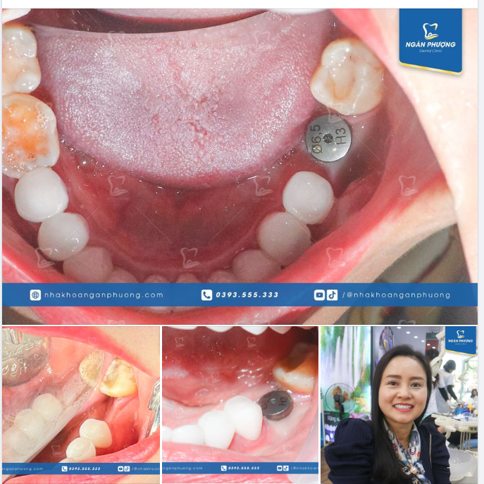 Chị Minh Nguyệt là khách hàng thân thiết đến nỗi đã chọn Ngân Phượng chăm sóc từ lấy cao răng, làm răng sứ và nay là cả trồng răng implant nữa.