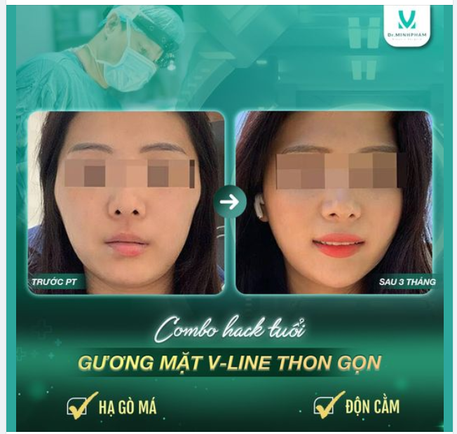 Combo Hạ gò má + Độn cằm Dr. Minh Phạm - cho khuôn mặt chuẩn Vline!