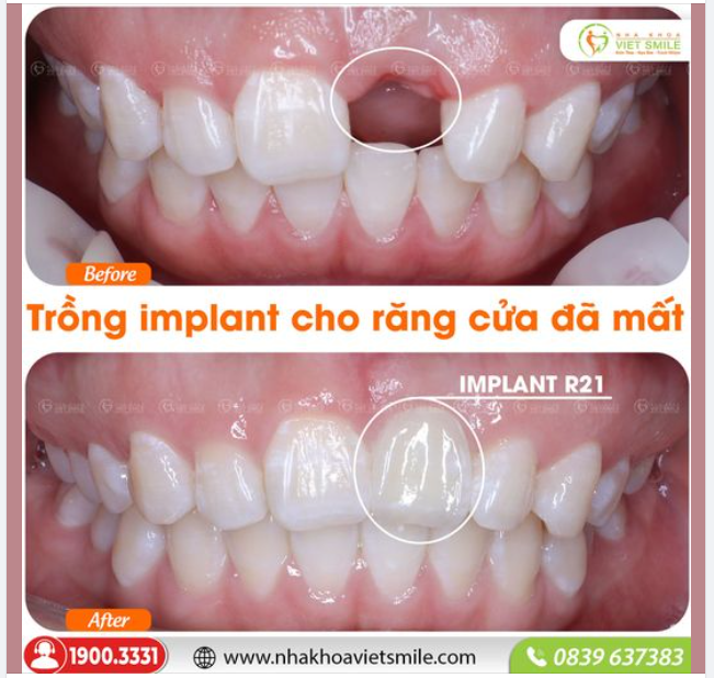 TRỒNG IMPLANT CHO RĂNG CỬA ĐÃ MẤT