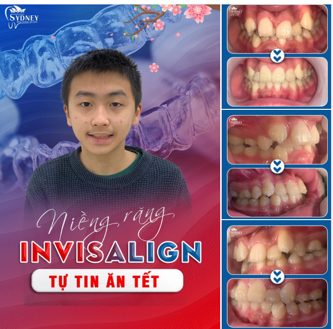 TỰ TIN ĂN TẾT VỚI NIỀNG KHAY TRONG SUỐT INVISALIGN