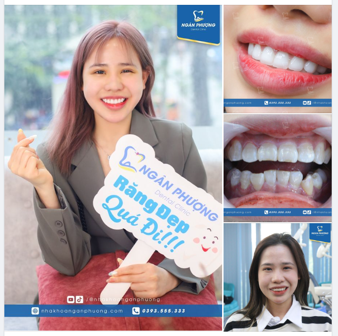 Tái khám sau 1 năm, không chỉ răng vẫn sáng đẹp mà nụ cười Ngọc Ánh đã tươi và cân đối hơn rất nhiều so với ban đầu.