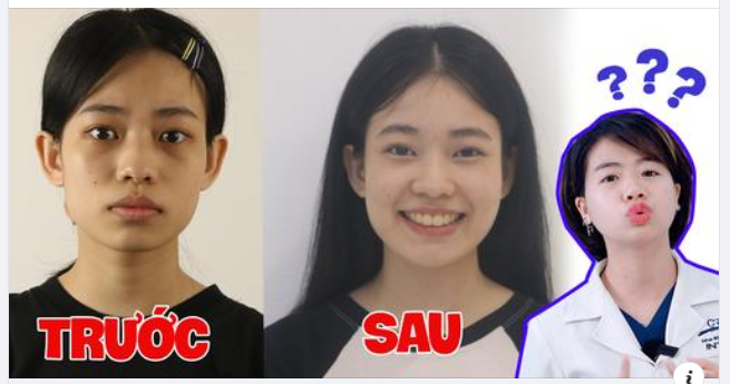 SỰ THẬT: Niềng răng có làm thay đổi gương mặt không?
