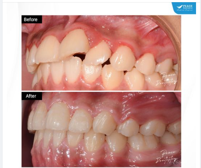 NIỀNG RĂNG CÓ THỂ NHANH HƠN BẠN NGHĨ NẾU:
